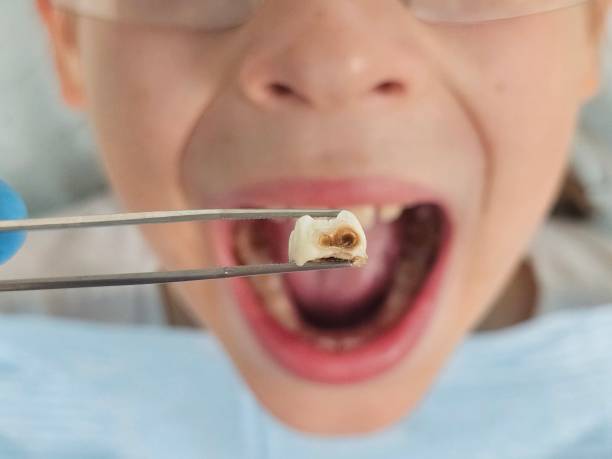 Best Emergency Tooth Extraction in Limestone, IL